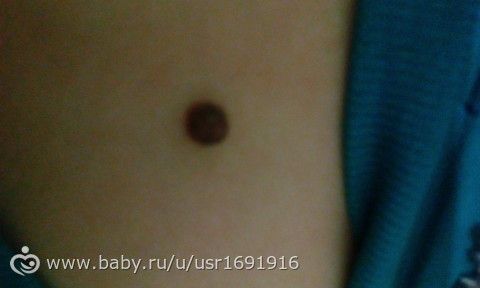 Ногтём задела родинку Ногтём задела родинку