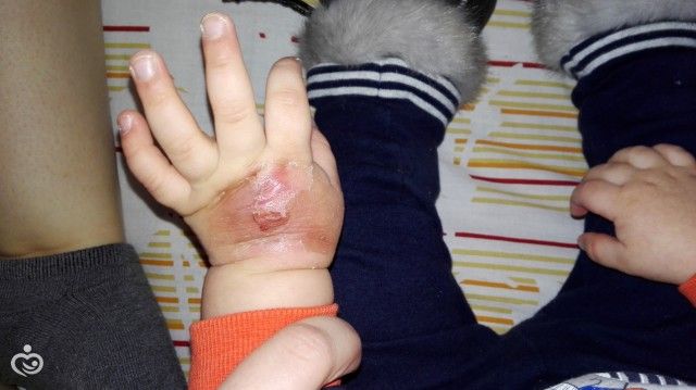 Что можно от ожогов ребенку в домашних условиях Что можно от ожогов ребенку в домашних условиях