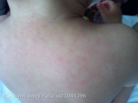Температура спадает появляется сыпь Температура спадает появляется сыпь