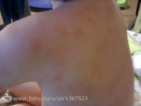 К кому обратиться при высыпаниях на коже К кому обратиться при высыпаниях на коже