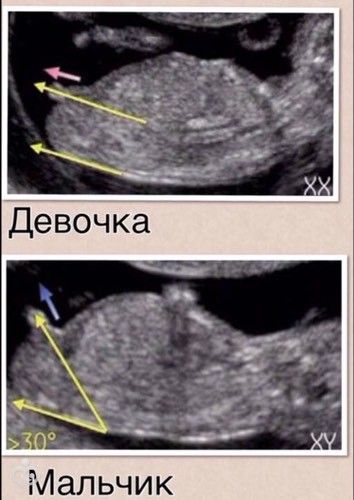 Узнать пол ребенка по первому скринингу Узнать пол ребенка по первому скринингу