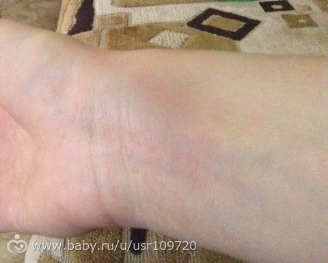 Вены на лице причины