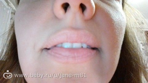Брекеты в 35 лет... стоит ли устанавливать???