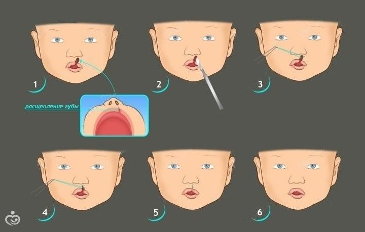 Заячья губа и Волчья пасть. Причины развития и лечение