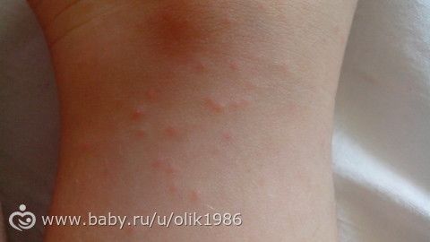 сыпь вв ребенка