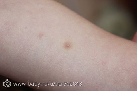 после диаскинтеста синячок фото
