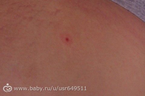Похож на укус клеща?