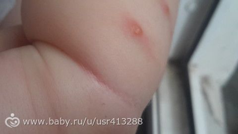 девчат посмотрите ветрянка или нет.