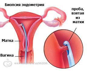Пайпель- биопсия эндометрия