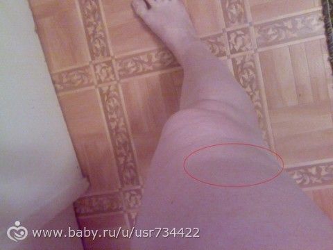 Впадина на ноге.