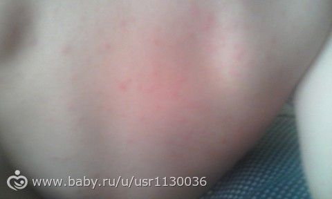 Подскажите потничка или аллергия?