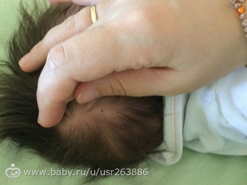 Очень переживаю !!!разве так рано бывают родинки ?!!!