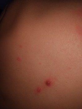 Что это за сыпь. От чего? Что это за сыпь. От чего?