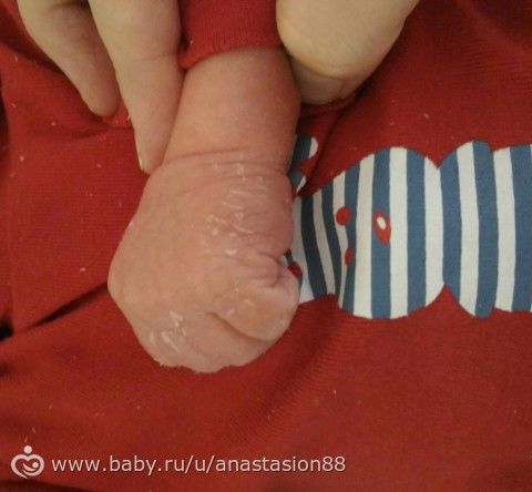 Сухость кожи у новорожденного, что делать+ фото? Сухость кожи у новорожденного, что делать+ фото?