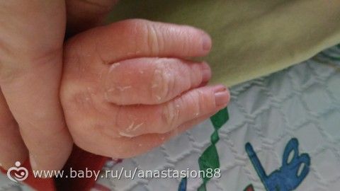 Сухость кожи у новорожденного, что делать+ фото? Сухость кожи у новорожденного, что делать+ фото?