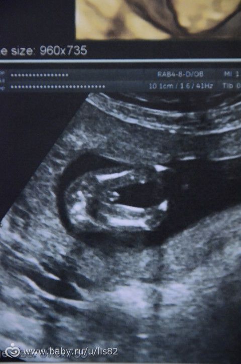 14 недель мальчик. УЗИ 14 недель беременности пол мальчик. УЗИ 16 недель беременности пол мальчик. Мальчик и девочка на УЗИ 14 недель. Половые органы девочки на УЗИ.