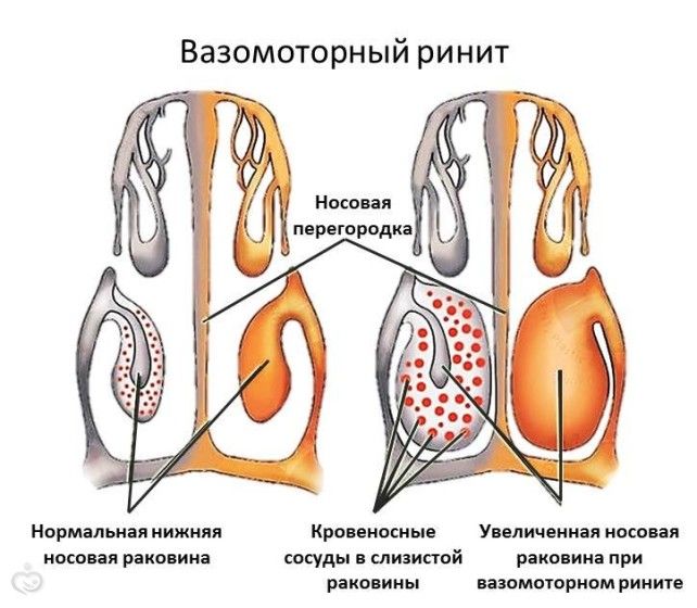 Заложенность носа при беременности — как избавится