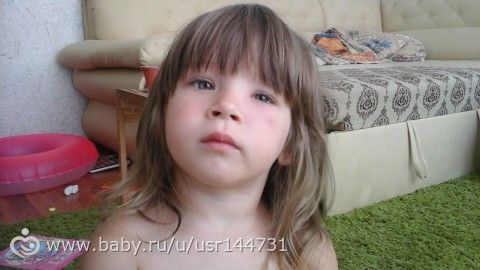 Девочки, СОС! Опух глазик у дочки! Фото!