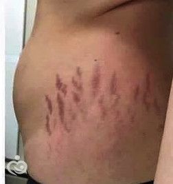 Как убрать растяжки после родов?