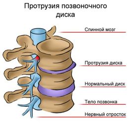 Рассказ о том, как я лечила свой остеохондроз, вдруг кому-то будет полезно Рассказ о том, как я лечила свой остеохондроз, вдруг кому-то будет полезно